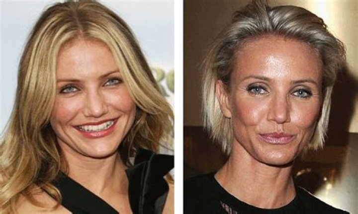 Cameron Diaz Plastic Surgery Before and After